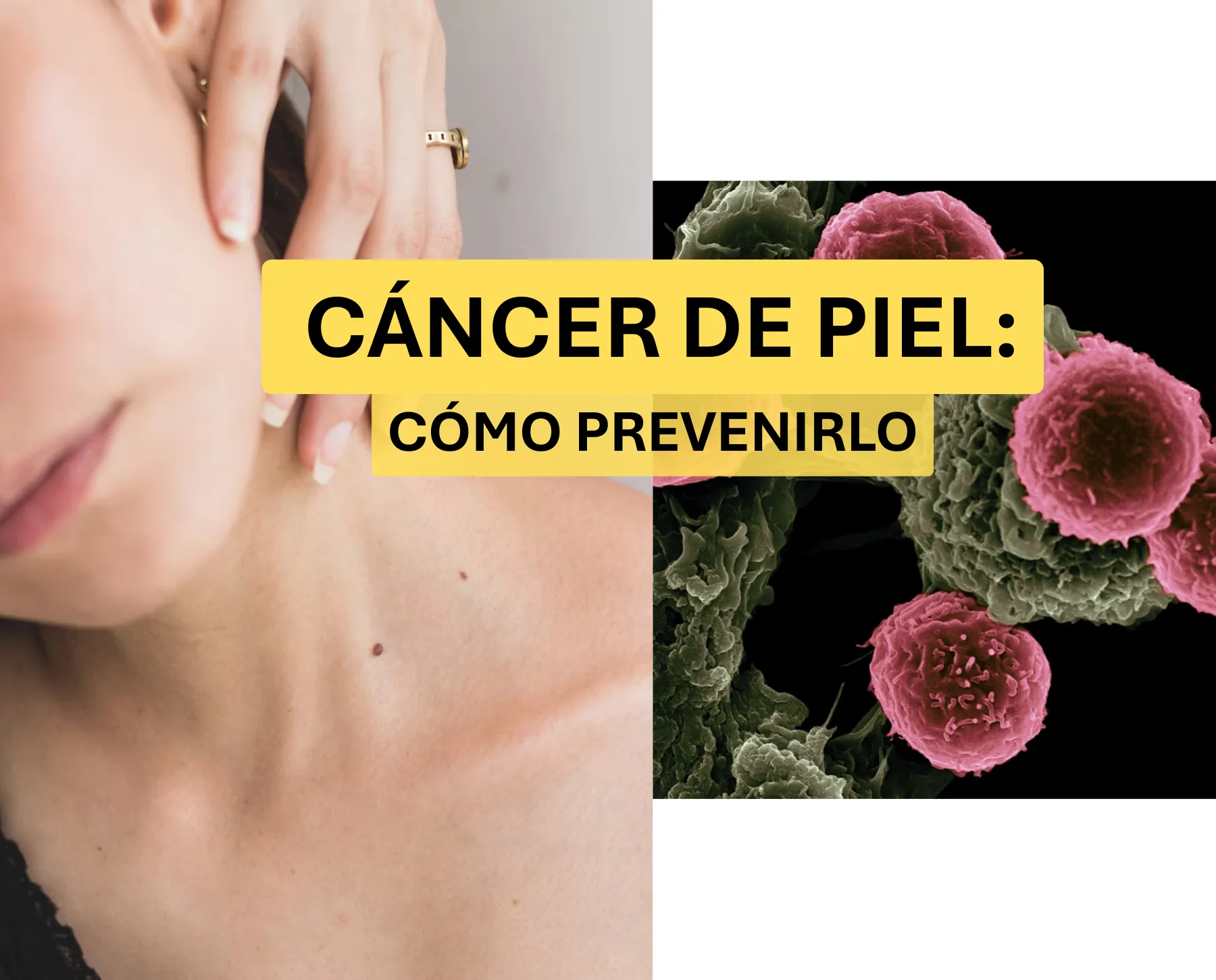 Cáncer de piel: Tipos, síntomas, prevención y tratamientos