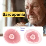 Sarcopenia: Causas, Síntomas, Diagnóstico, Tratamiento y Prevención Completa