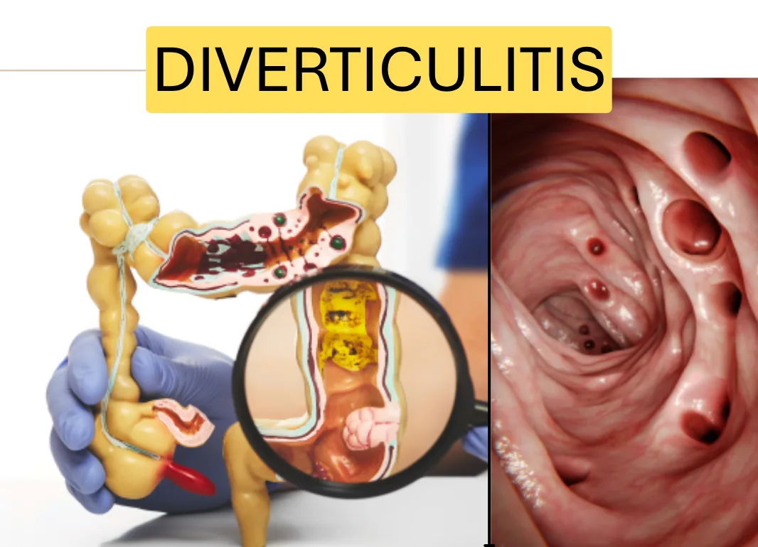 Cinco Alimentos que Debes Evitar si Tienes Diverticulitis