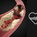 Infarto de Miocardio: Todo lo que Necesitas Saber sobre Causas, Síntomas, Riesgos y Prevención